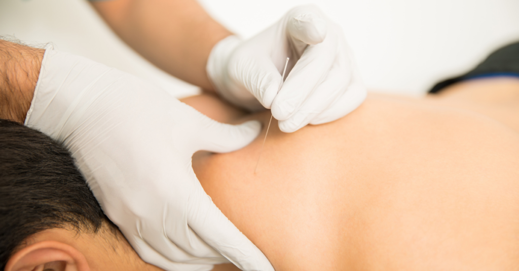 Expert dry needling treatment provided by Merrill Physical Therapy's skilled therapists in Merrill, Wisconsin.
